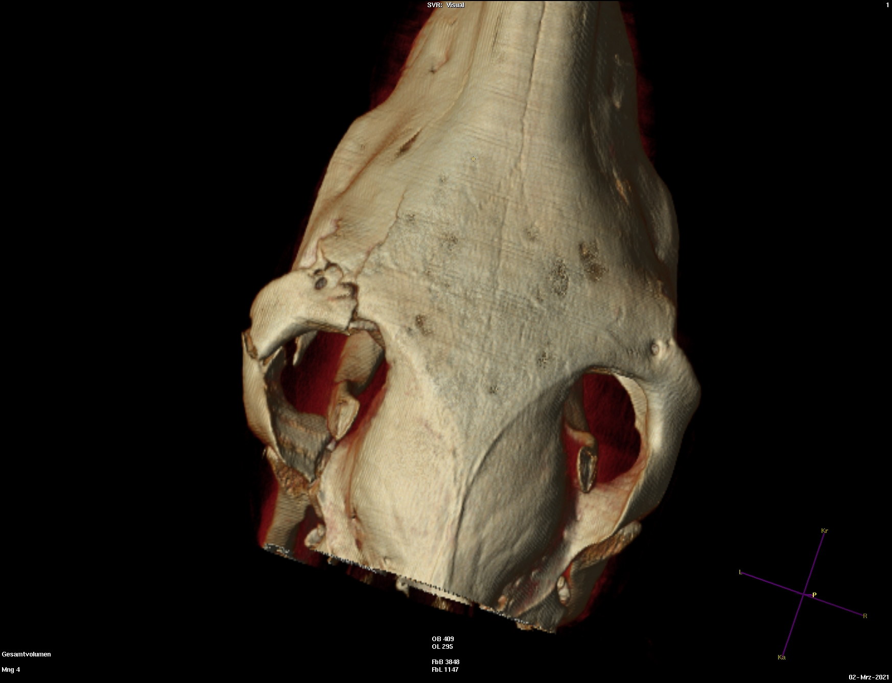 Surgery Case Orbital Floor